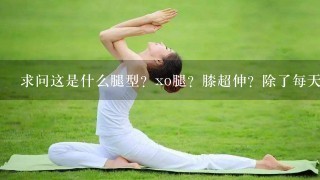 求问这是什么腿型？xo腿？膝超伸？除了每天无氧有氧该怎么矫正